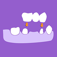 Dental crowns and bridges Costa Rica