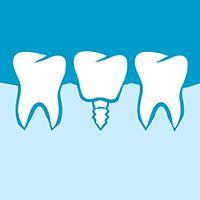 Affordable Dental implants Costa Rica