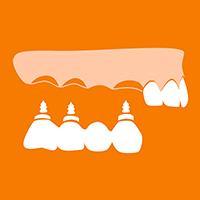 Dental implants Costa Rica