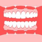 All-on-4 dental implants Costa Rica